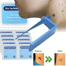 Medical micro skin tag remover Skin Mole Wart Remover Micro Band Skin Tag Remova