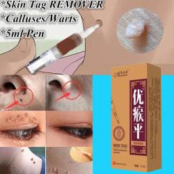 Skin Tag Remover Pen 12 Hours Tu Kill Remover Medical Skin Tag Mole Genital Wart